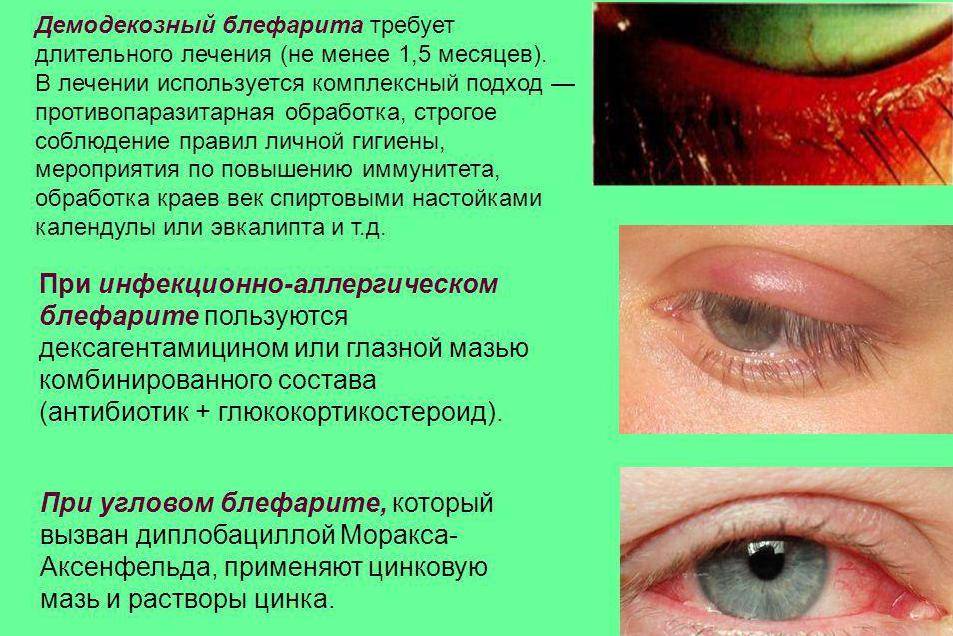 Особенности заболевания глаз блефарит: как лечить недуг