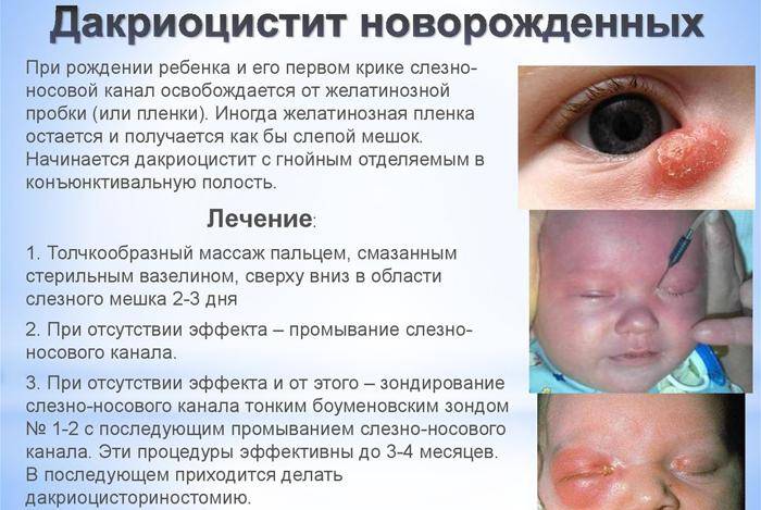 Аллергия: покраснение глаз и отек, насморк, чихание и другие симптомы