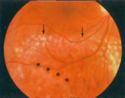 Ретиношизис сетчатки глаза: что это такое и как лечить?