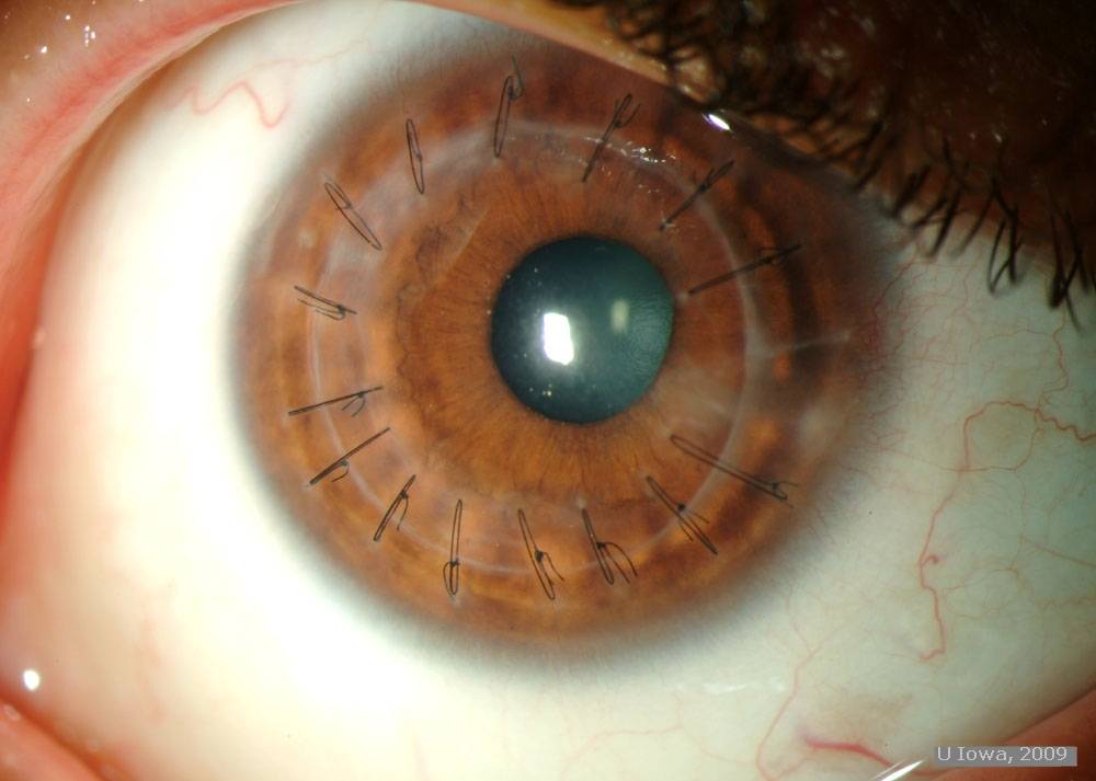 Пересадка роговицы глаза: восстановление, осложнения, виды