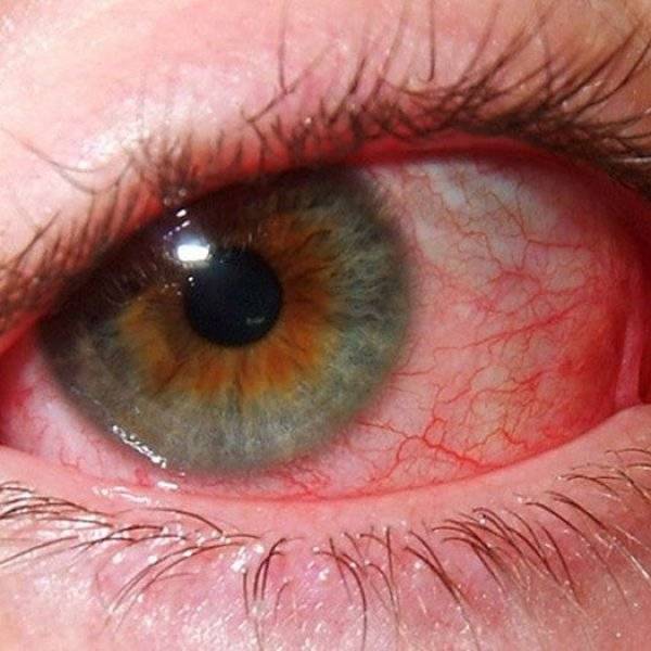 Хориоретинит глаз: что это такое, симптомы и лечение