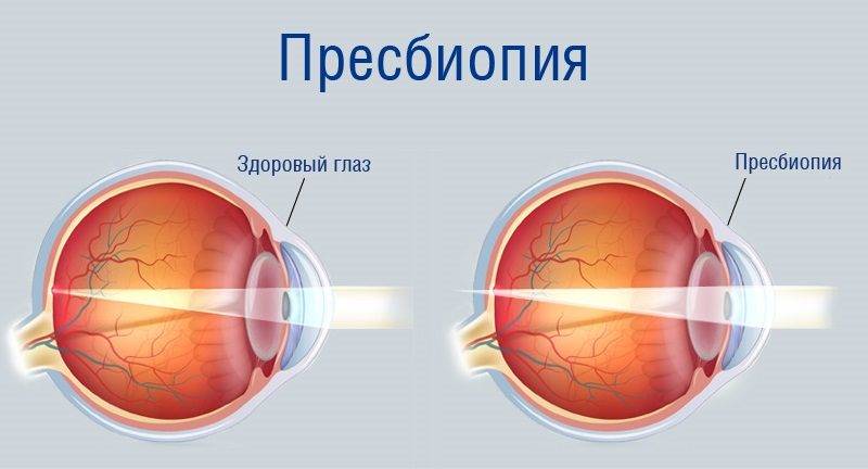 Что такое пресбиопия глаза и как её лечить oculistic.ru
что такое пресбиопия глаза и как её лечить