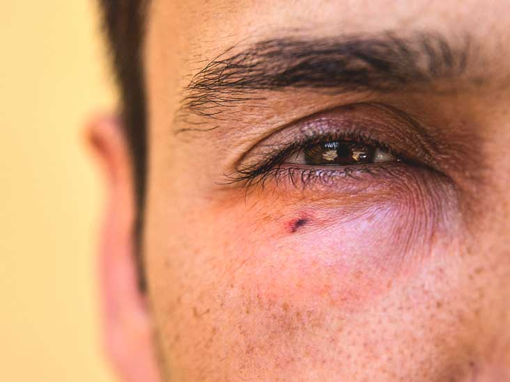 Ушиб глазного яблока - симптомы травмы и методы лечения