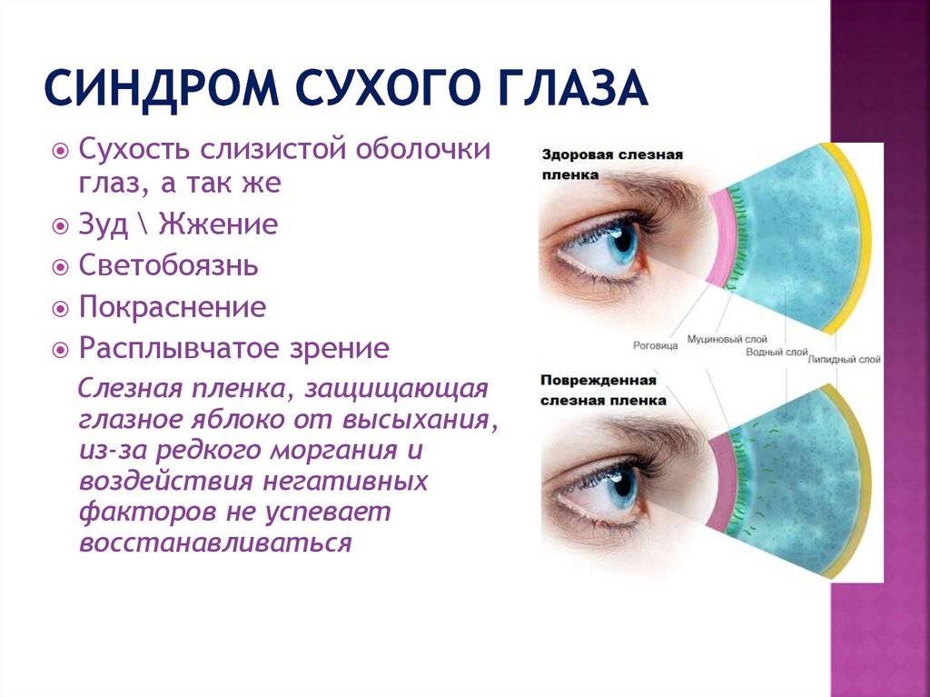 Синдром сухого глаза – диагностика, симптомы и лечение