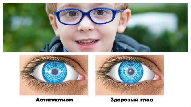 Астигматизм у ребенка (36 фото): что это такое, лечение глаз при сложной гиперметропической форме, как обследовать, причины
