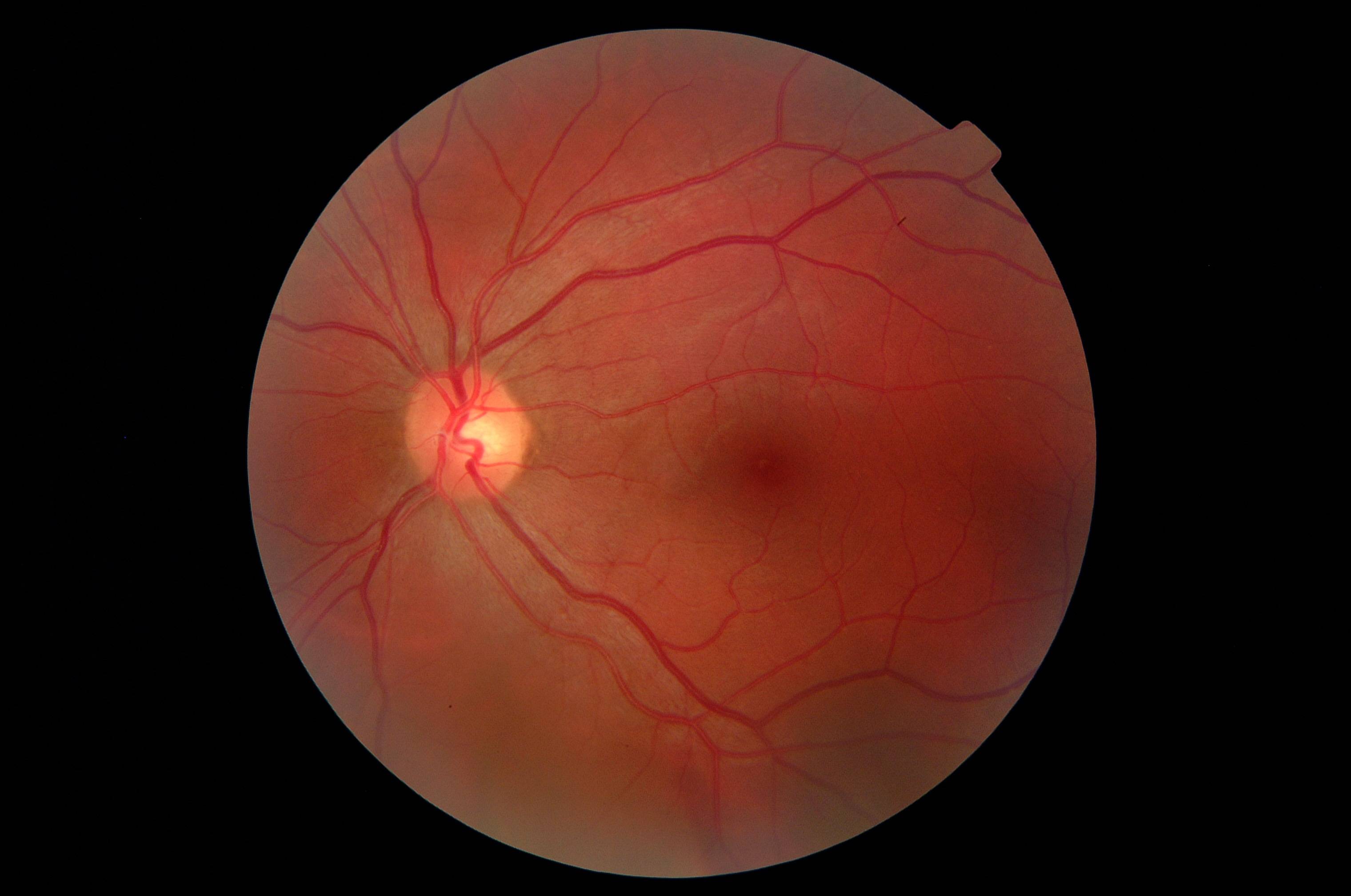 Макулодистрофия сетчатки глаза - что это, лечение, операция, причины и симптомы