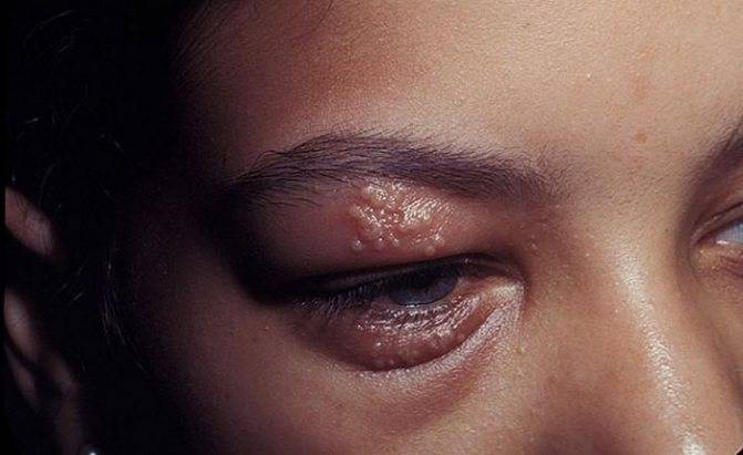 Герпес на глазу: симптомы и лечение