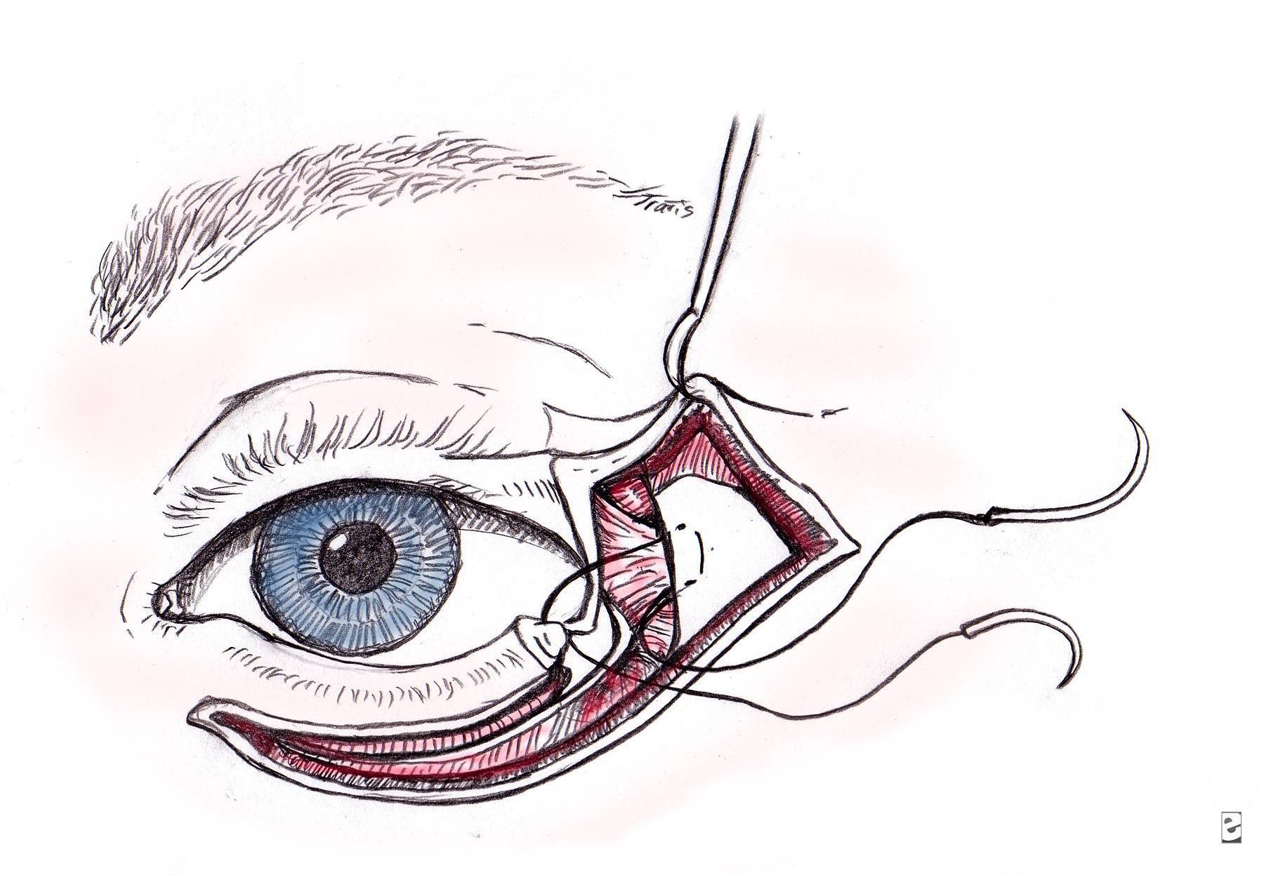 Внешние уголки глаз красные - вопрос офтальмологу - 03 онлайн