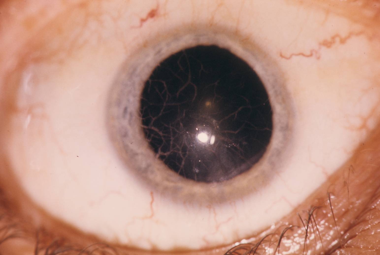 Что такое дистрофия роговицы глаза: симптомы, лечение oculistic.ru
что такое дистрофия роговицы глаза: симптомы, лечение