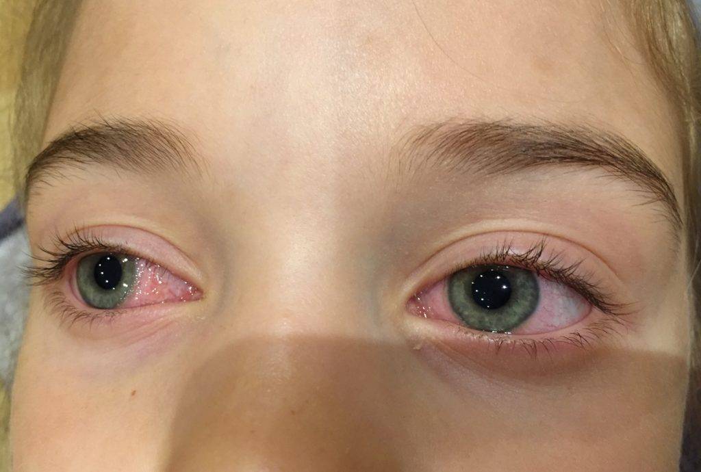 Аллергия на линзы — аллергия