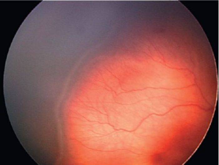 Причины, симптомы и лечение ретинопатии у недоношенных детей