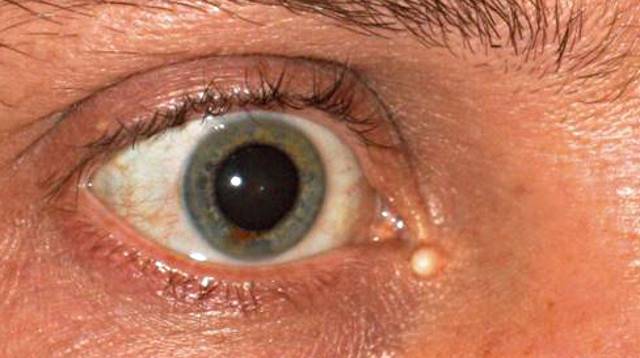Киста на веке глаза: причины, симптомы и методы лечения - "здоровое око"
