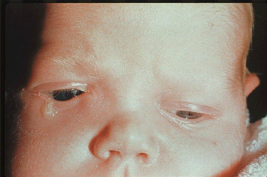 Дакриоцистит у новорожденных - причины, лечение, последствия