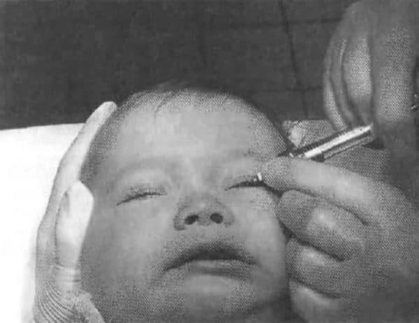 Зондирование слезного канала у новорожденных: видео доктор комаровский