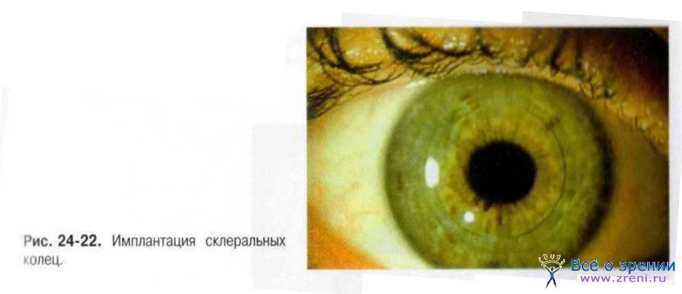 Операция помогает не всем? почему после лазерной коррекции зрения один глаз видит хуже другого