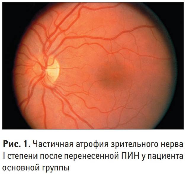 Атрофия зрительного нерва: лечение, частичная, симптомы