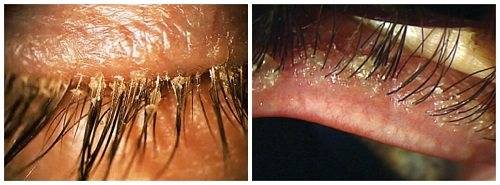Ресничный клещ или глазной клещ (демодекс): симптомы и лечение