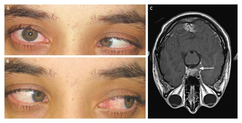 Диплопия глаза: что представляет собой эта патология, лечение народными средствами монокулярной диплопии