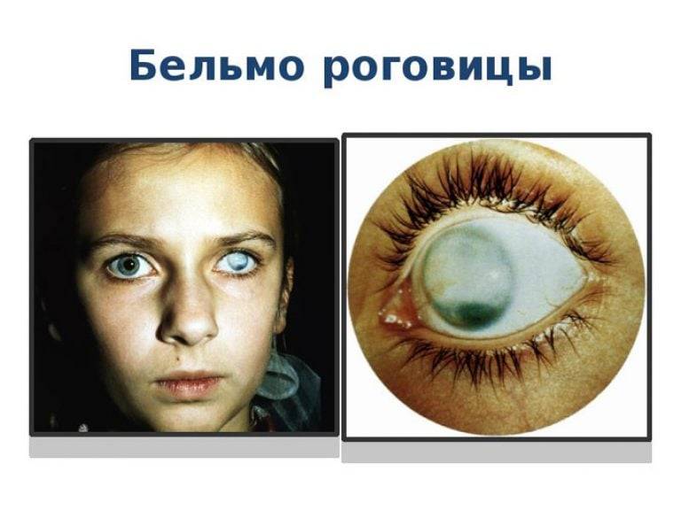 Бельмо: это что такое, лейкома роговицы на глазу у человека, фото, код по мкб-10, васкуляризированная разновидность