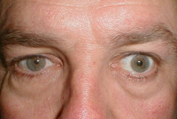 Суженные зрачки: возможные причины, профилактика и лечение - "здоровое око"