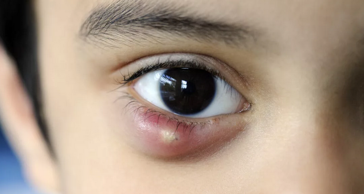 Ячмень на глазу: как избавиться от ячменя на глазу: 10 простых домашних средств - ячмень, глаза, народные средства, лечение