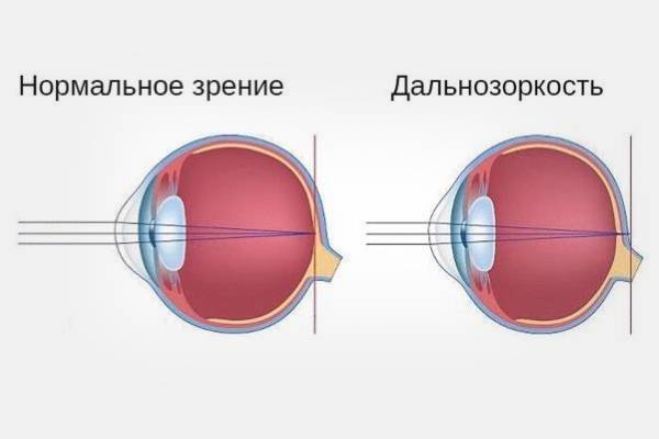 Дальнозоркость: это "плюс" или "минус" зрения, причины развития, симптомыи признаки гиперметропии у взрослых, лечение