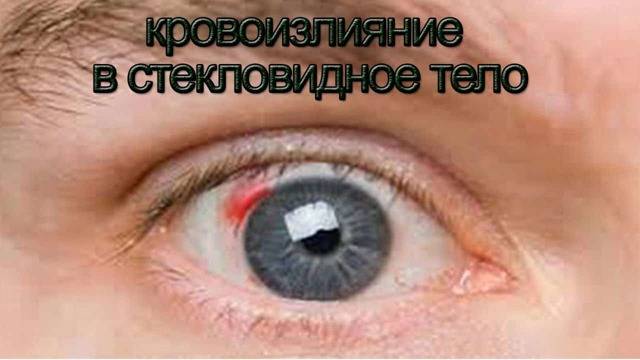 Как лечить субконъюнктивальное кровоизлияние в сетчатку глаза и что делать когда идет кровь в стекловидное тело