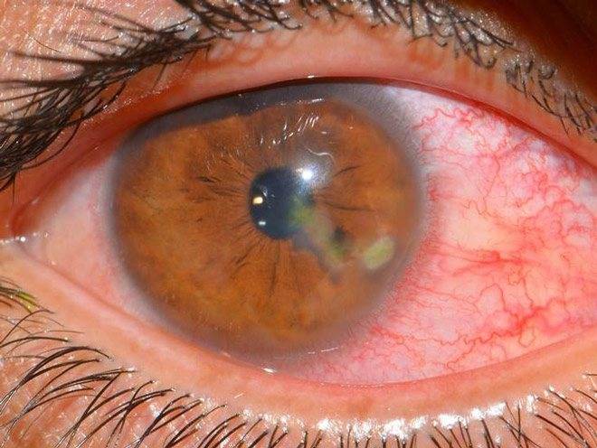 Кератит: симптомы и лечение воспаления роговицы глаза, виды заболевания (вирусный, акантамебный, грибковый)