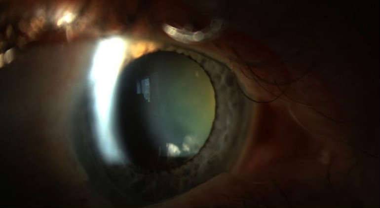 Факосклероз хрусталика глаза: что это такое, симптомы, лечение факосклероза