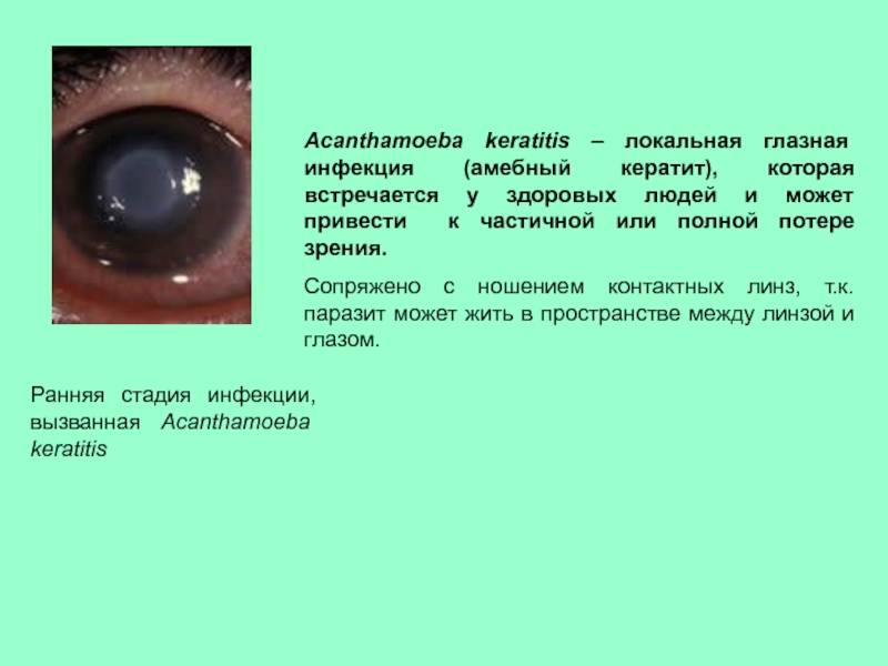 Причины и лечение острого кератита глаза