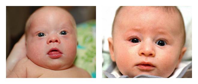 Мешки под глазами у грудничка, почему они появляются у новорожденного