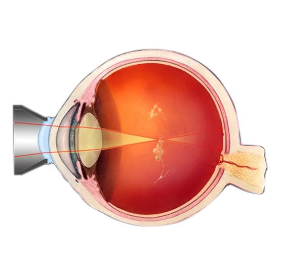 Прозрачное тело в глазу. Yag-лазерный витреолизис. Лазерный витреолизис и стекловидное тело /. Деструкция витреолизис.