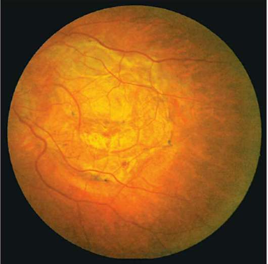Что такое хориоретинальная дистрофия сетчатки глаза?