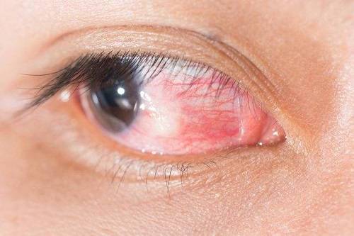 Эписклерит глаза: причины и методы лечения