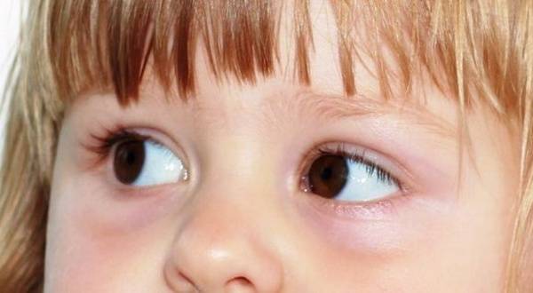 Аллергический конъюнктивит у детей и его особенности