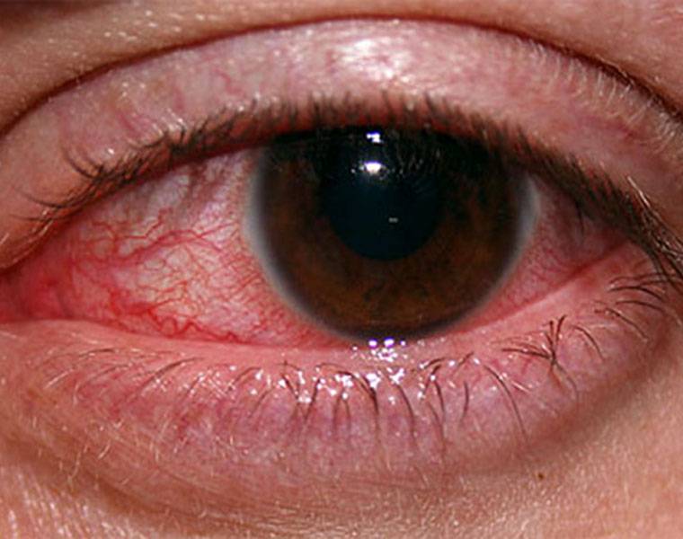 Как определить герпес на глазах и не допустить ошибок при лечении