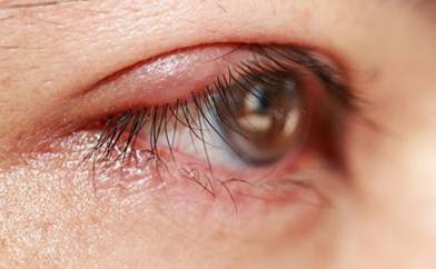 Киста глаза – причины, лечение, удаление, виды, симптомы