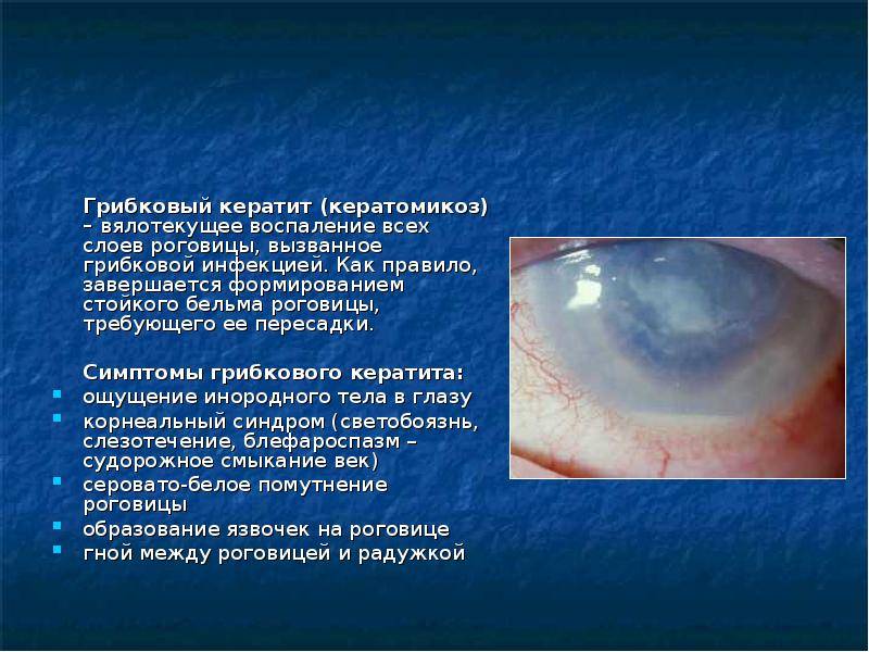 Кератит — симптомы и лечение воспаления роговицы глаза