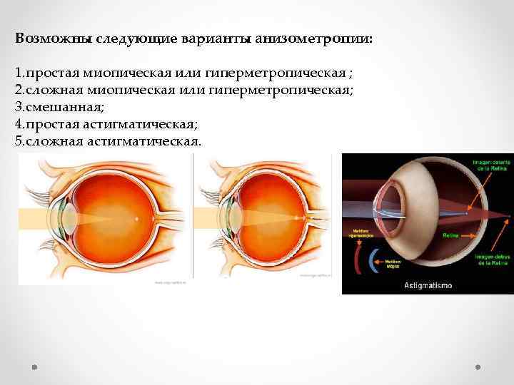 Аметропия  что это за заболевание. что нужно знать о аметропии глаза