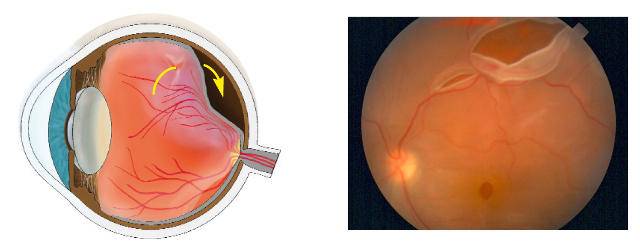 Дистрофия сетчатки глаза: причины, симптомы дегенерации, лечение истончения уколами, каплями и народными средствами