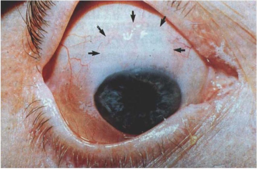 Вторичная глаукома: причины, виды, стимптомы, методы лечения и восстановления зрения — глаза эксперт