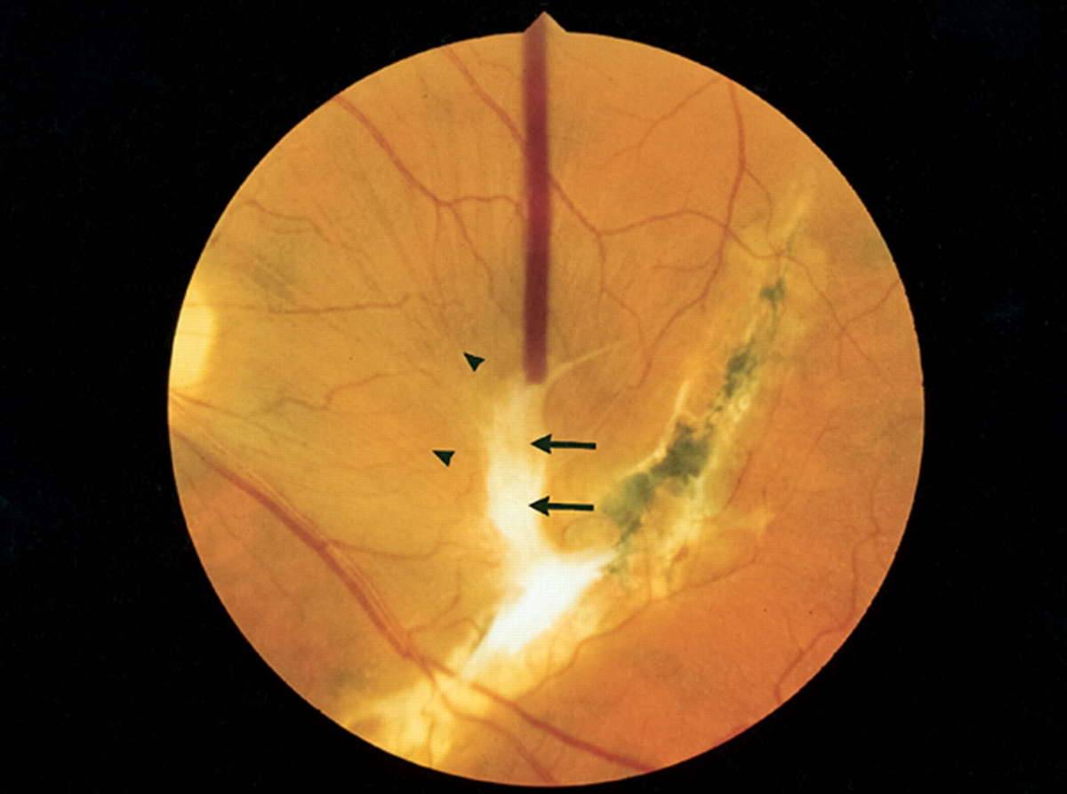Лечение отслойки сетчатки – виды операций, прогноз для восстановления зрения