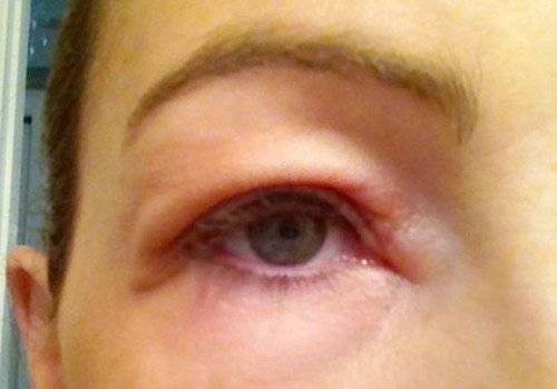Отек глаз при аллергии - что делать и как быстро снять?