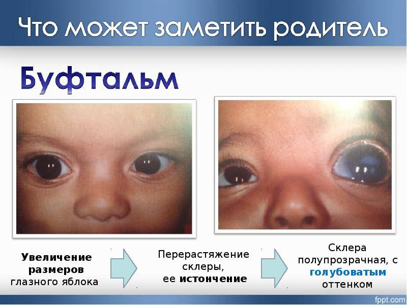 Глаукома у детей | симптомы и лечение глаукомы у детей | компетентно о здоровье на ilive