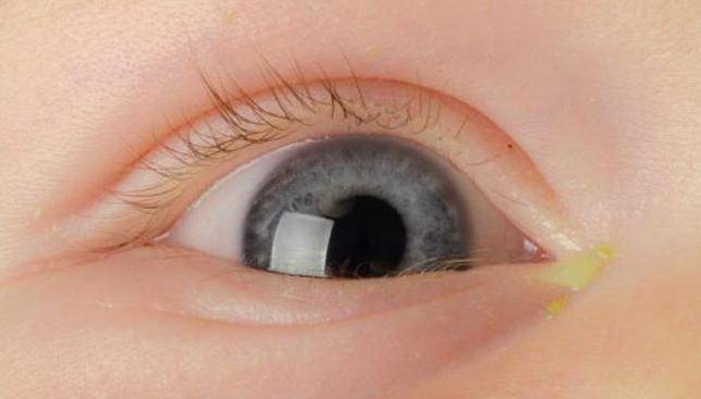 Гноится глаз у ребенка: причины, лечение