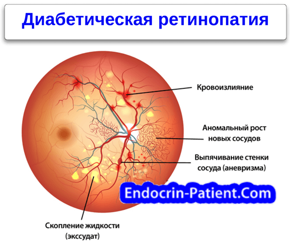 Диабетическая ретинопатия - что это такое, симптомы, лечение, виды