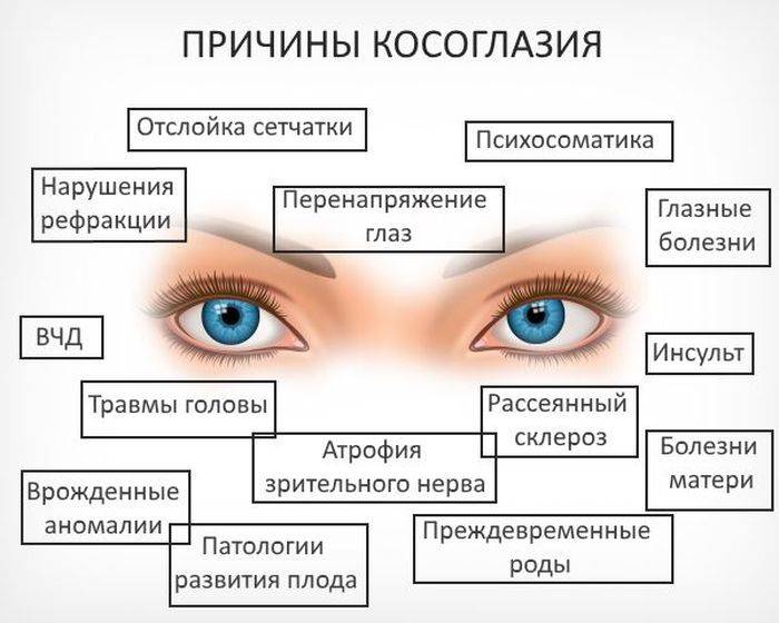 Амблиопия или ленивый глаз, симптомы, лечение