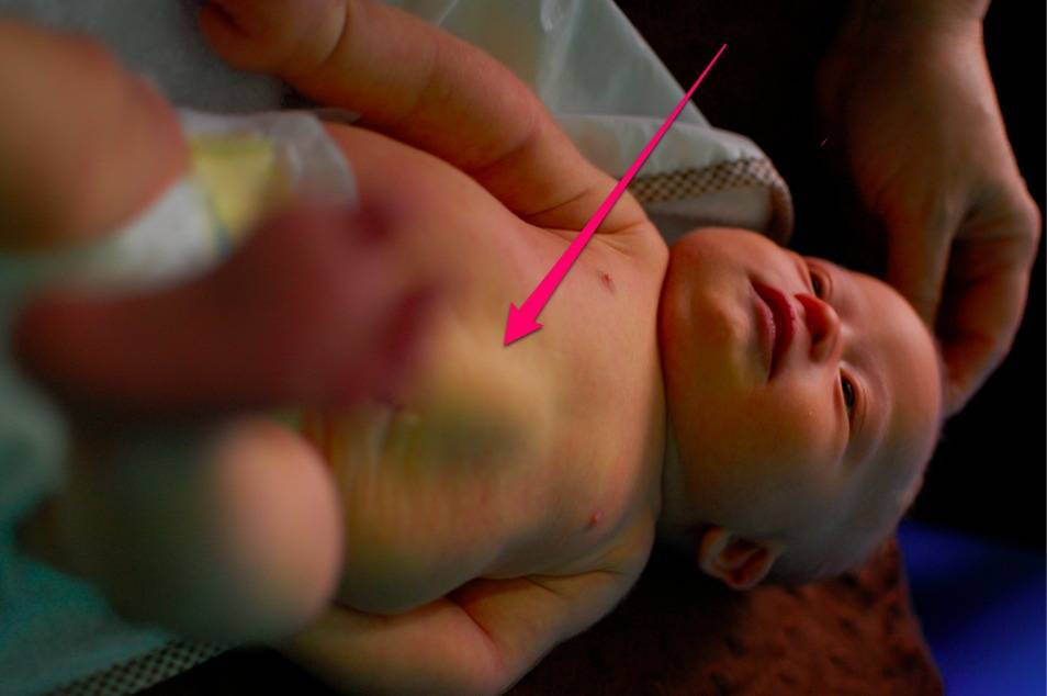 Ангиопатия сетчатки при беременности. какие роды при этой болезни? — глаза эксперт