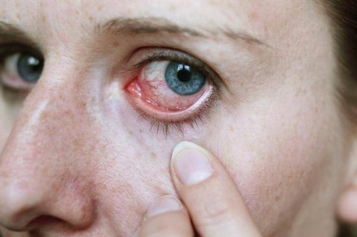 Раздражение от контактных линз. как избежать аллергии на контактные линзы: советы. контактные линзы и аллергия