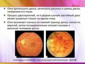 Неврит зрительного нерва: симптомы, лечение и прогноз заболевания